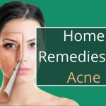 Home Remedies for Acne: Effective ways to get rid of acne
