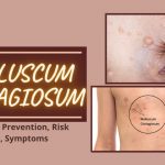 Molluscum Contagiosum: Treatment, Symptoms, Risk Factors, Prevention