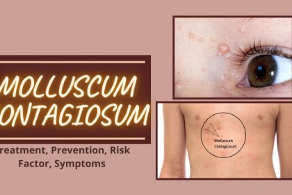 Molluscum Contagiosum: Treatment, Symptoms, Risk Factors, Prevention