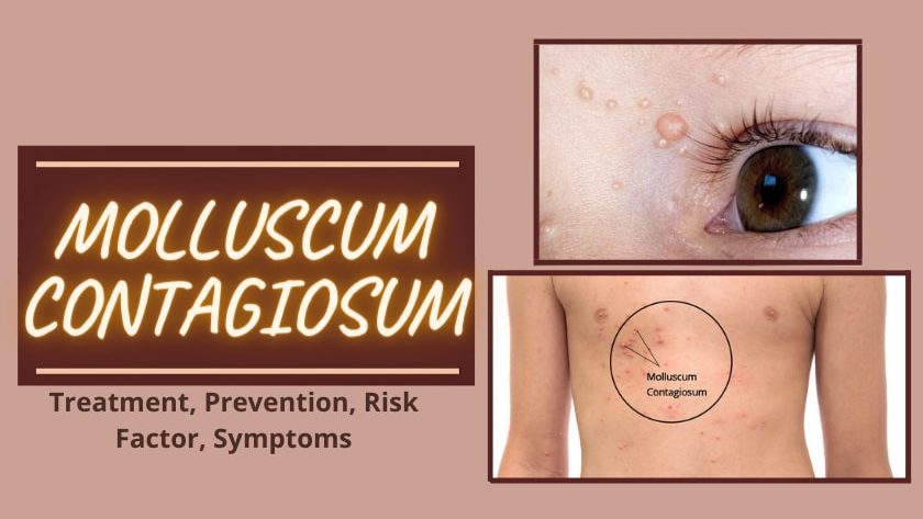 Molluscum Contagiosum: Treatment, Symptoms, Risk Factors, Prevention